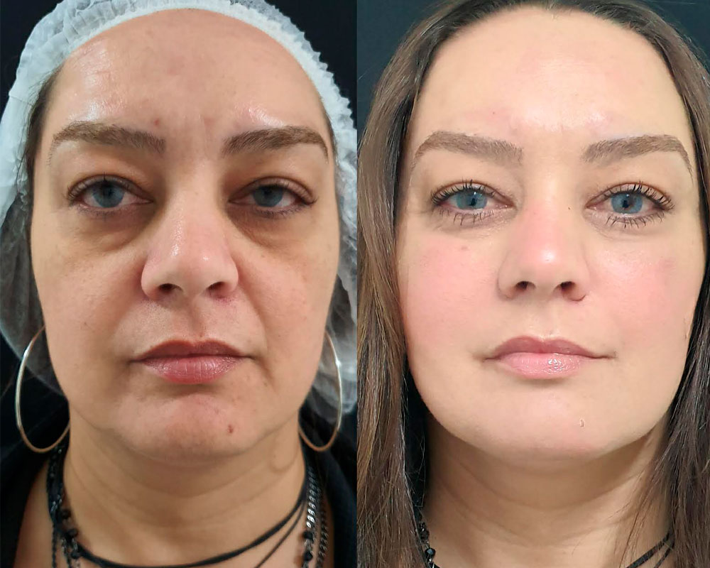 Estética Facial Preenchimento Facial MD Codes Clínica Belle Harmony